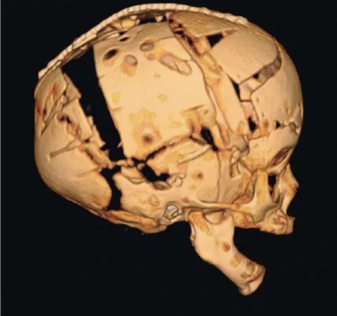 Пример техники операции при Скафоцефалии