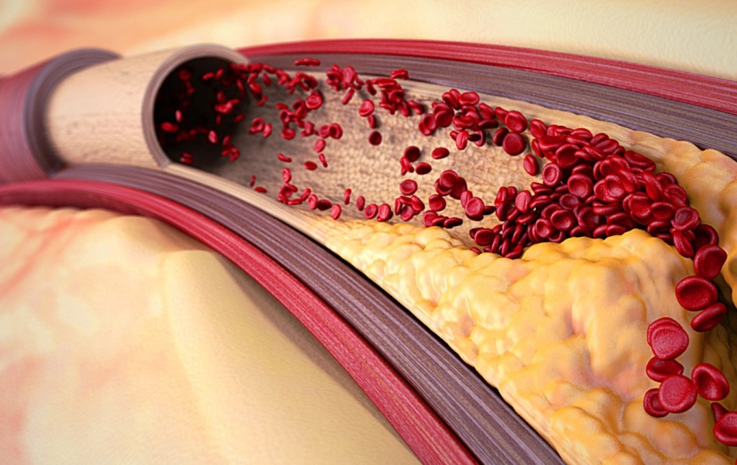 Как очищается кровь. Атеросклеротическая бляшка. Кровяные бляшки в сосудах. Кровеносные сосуды от холестериновых бляшек;. Атеросклеротические бляшки в сосудах.