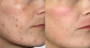 Пиявки нашли широкое применение в косметологии благодаря способности влиять на местные обменные процессы.