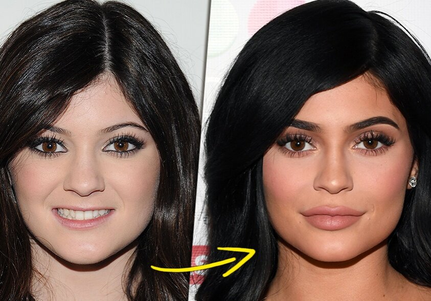 Кайли до, и после увеличения губ