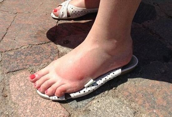 
Аллергия на укусы насекомых может иметь общие и местные проявления. Вторые – наиболее легкий вариант патологического состояния