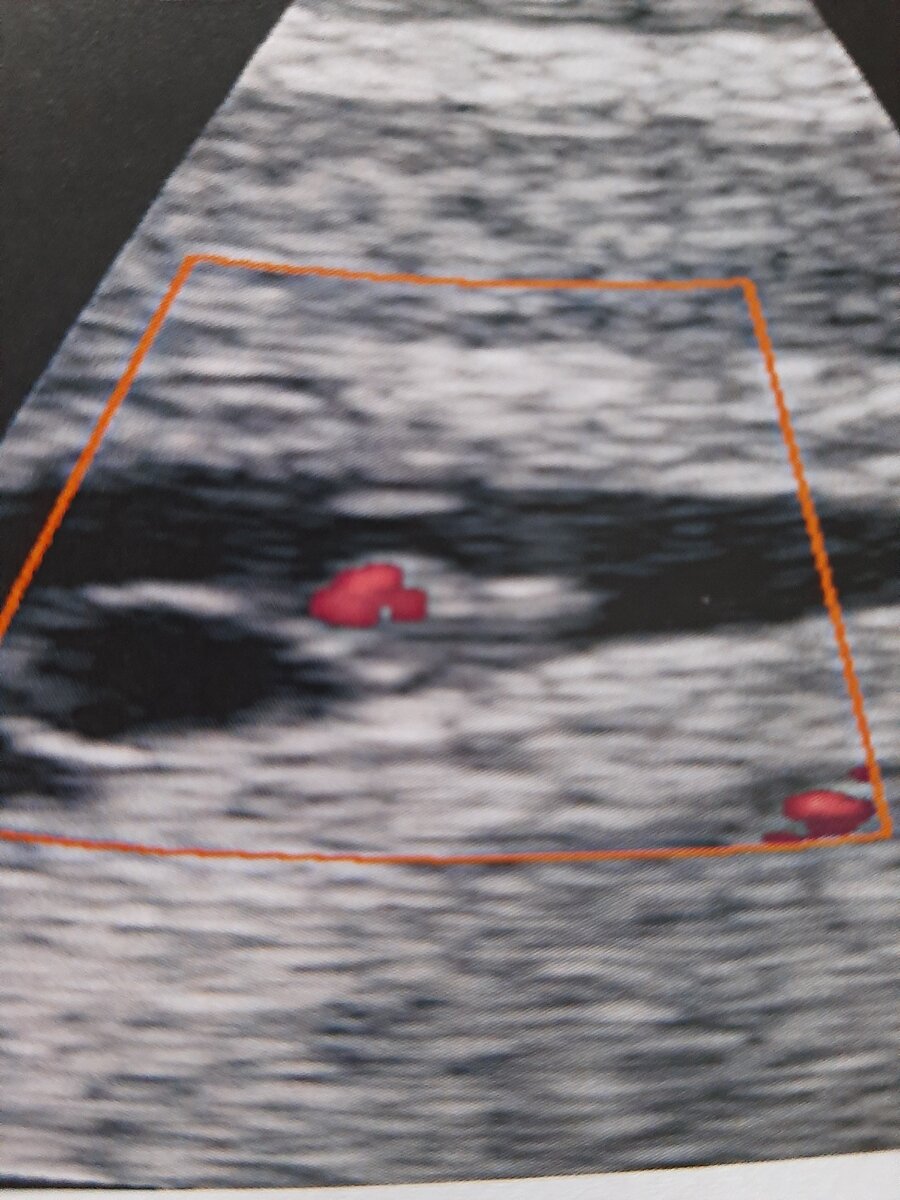 Видим кровоток в сердечной трубке плода. Фото любезно предоставлено кафедрой лучевой диагностики.