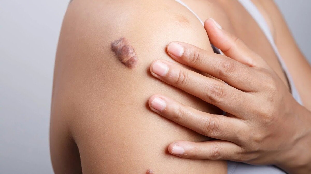 Как навсегда избавиться от рубцов и шрамов