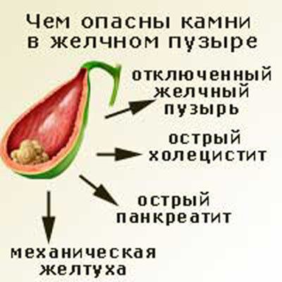 Чем опасны желчные камни
