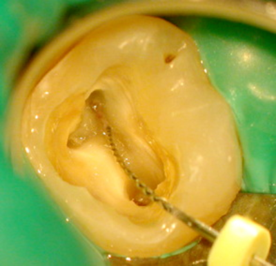 Лечение корневых каналов под микроскопом