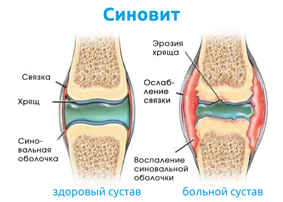 Что такое гонартроз и как его лечить в домашних условиях?