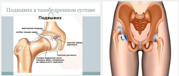 Защемление седалищного нерва (Ишиалгия) - Vertebra