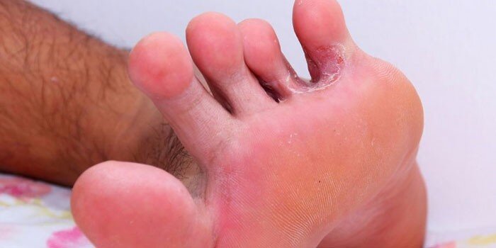 ...поражение стопы и межпальцевый грибок...