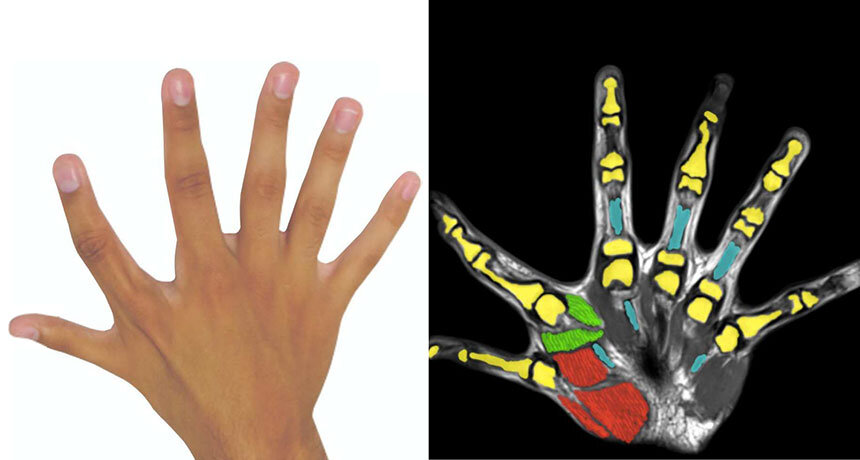Изображение: youtube. Лишним пальцем правой руки 17-летнего парня управляют его собственные мышцы (красные и зеленые) и сухожилия (синие).