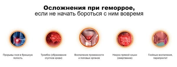 Геморрой - симптомы, лечение, причины и профилактика геморроя - Гармония