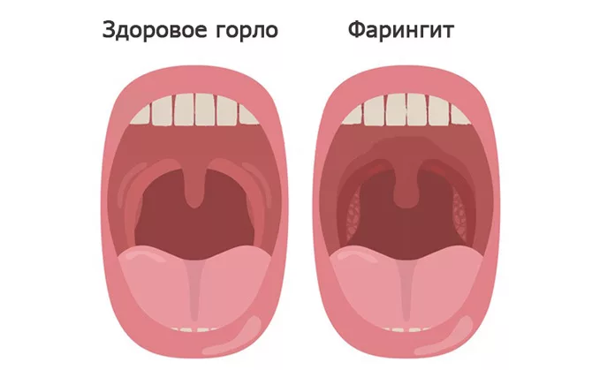 narod-dok.ru/otorinolaringologiya/faringit/