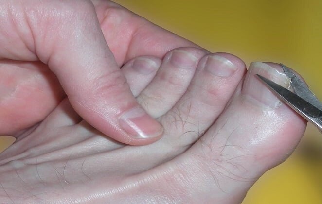 5 простых способов остричь жёсткие, утолщённые ногти на ногах
