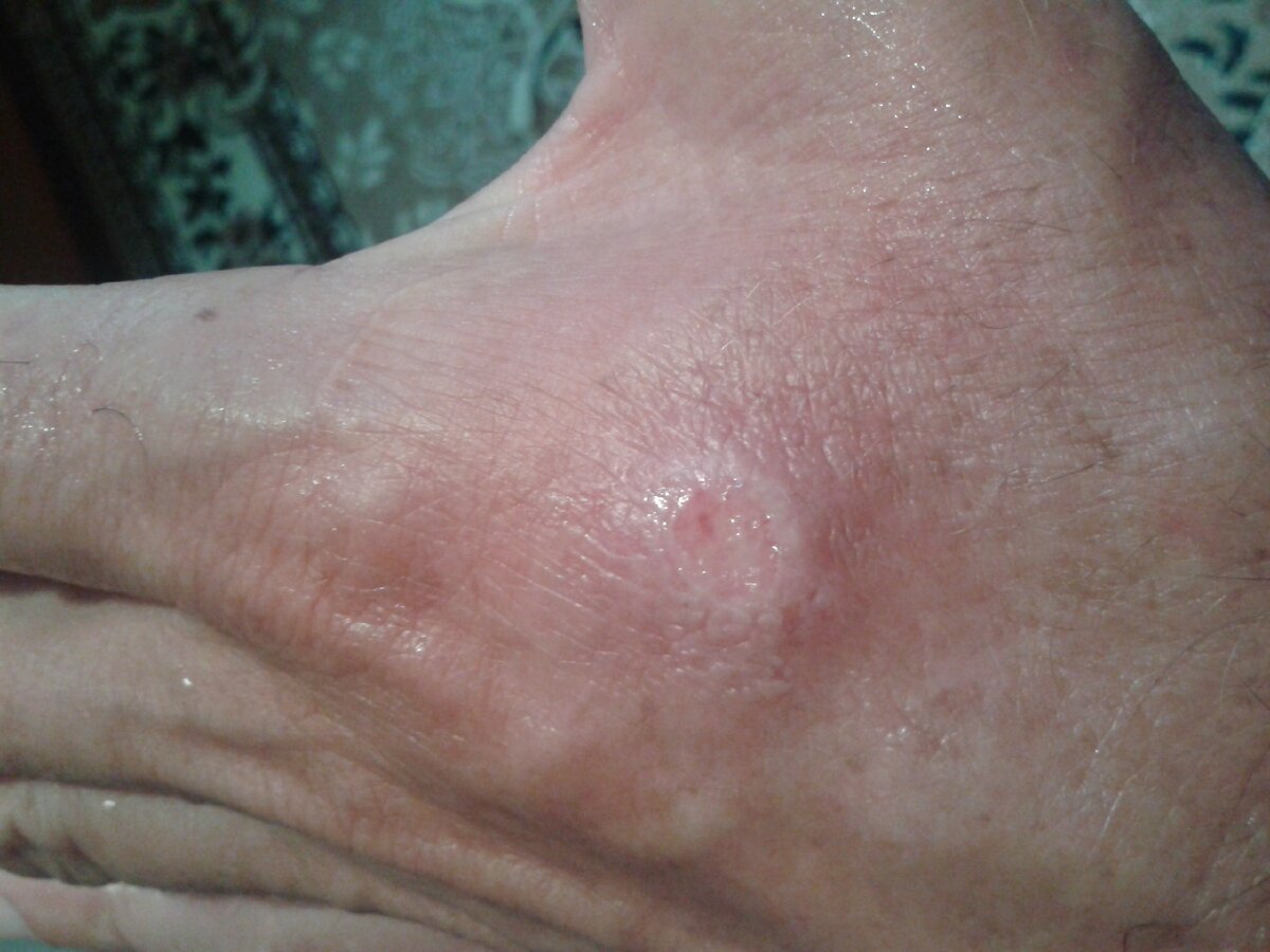 Почти затянувшаяся Трофическая язва