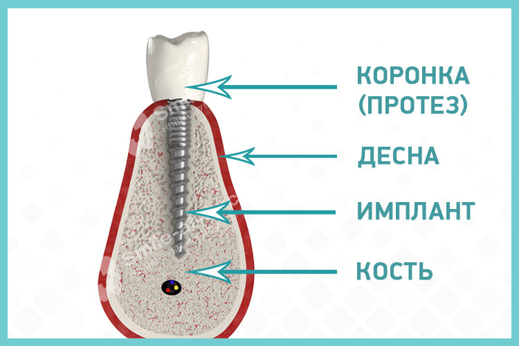 Уход за имплантами