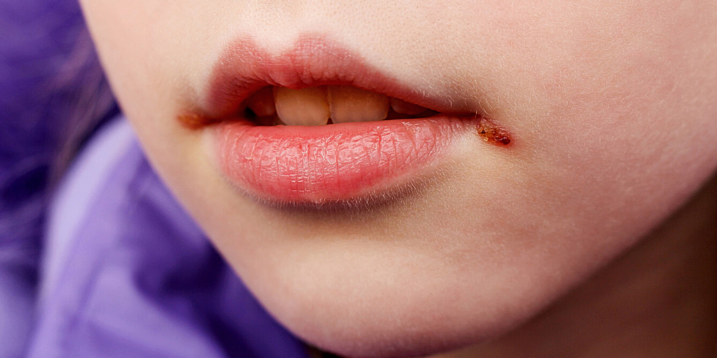 Стрептококковый хейлит.