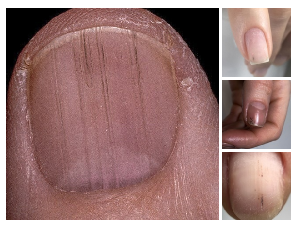 Черные полоски на ногте