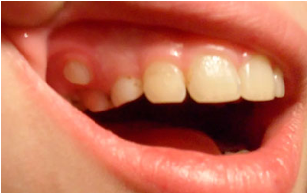 Молочные зубы у взрослых! – Аномалия или норма? - Стоматология Aliksma