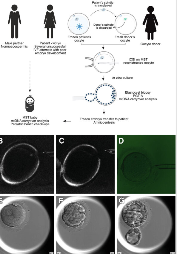 Обзор процедуры переноса материнского веретена деления  (MST).
(A) Схематическое изображение процесса MST. (B-G) Репрезентативные изображения процедуры MST из цикла PTMST-02, в результате которой родился первый ребенок MST (BBMST-01). Процесс MST включал перенос веретена ооцита пациентки, визуализированного в поляризованном свете (B, C), в свежий энуклеированный ооцит донора (D). Реконструированные ооциты были осеменены спермой партнера пациентки путем интрацитоплазматической инъекции сперматозоидов и культивированы in vitro. (E) Оплодотворенный ооцит с 2 пронуклеусами превратился в (F) уплотненную морулу и (G) бластоцисту через 5 дней после осеменения. Бластоцисты с хорошей морфологией были подвергнуты биопсии, проверены на хромосомную нормальность и перенос мтДНК.