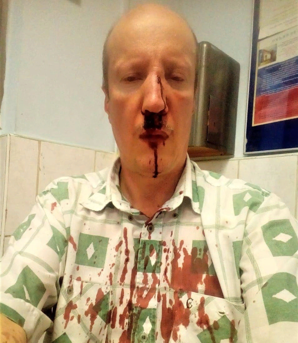 Сергей Бабаев после нападения директора ГБУ "Жилищник района Братеево" Рината Шарафетдинова. Фото: www.facebook.com.
