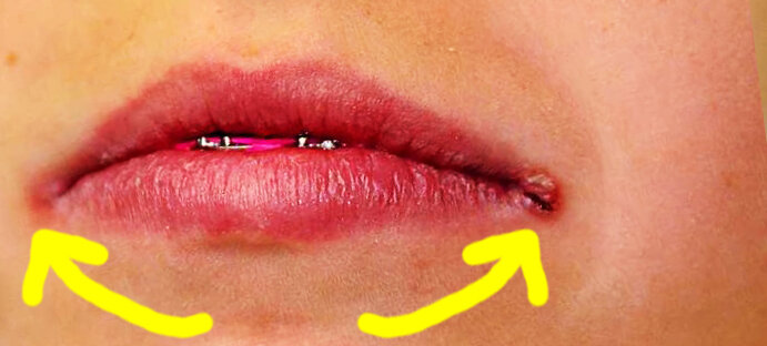 Двусторонняя заеда в области уголков рта.