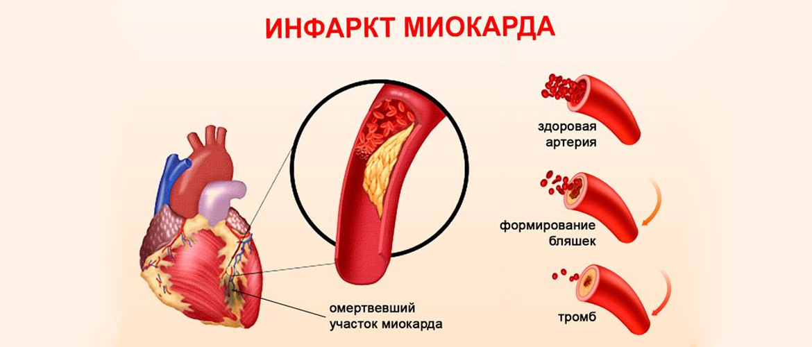 К инфаркту приводит закупорка коронарной артерии  атеросклеротической бляшкой и тромбом