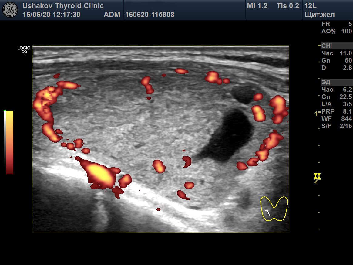 Щитовидная железа узлы лечение. Узлы в щитовидной железе. Узел в щитовидной железе с кровотоком. Кровоток в узле щитовидной. Кровоток щитовидной железы УЗИ.