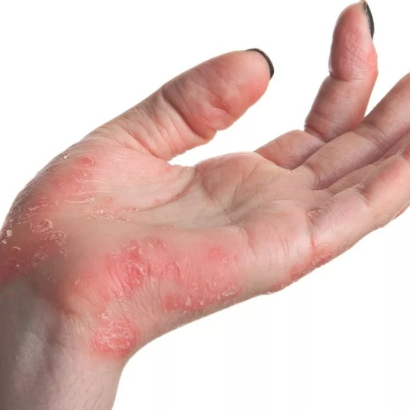 Источник: Европейский Медицинский Центр. URL: https://www.emcmos.ru/disease/ekzema-simptomy-i-sposoby-lecheniya/ (дата обращения: 13.06.2021).