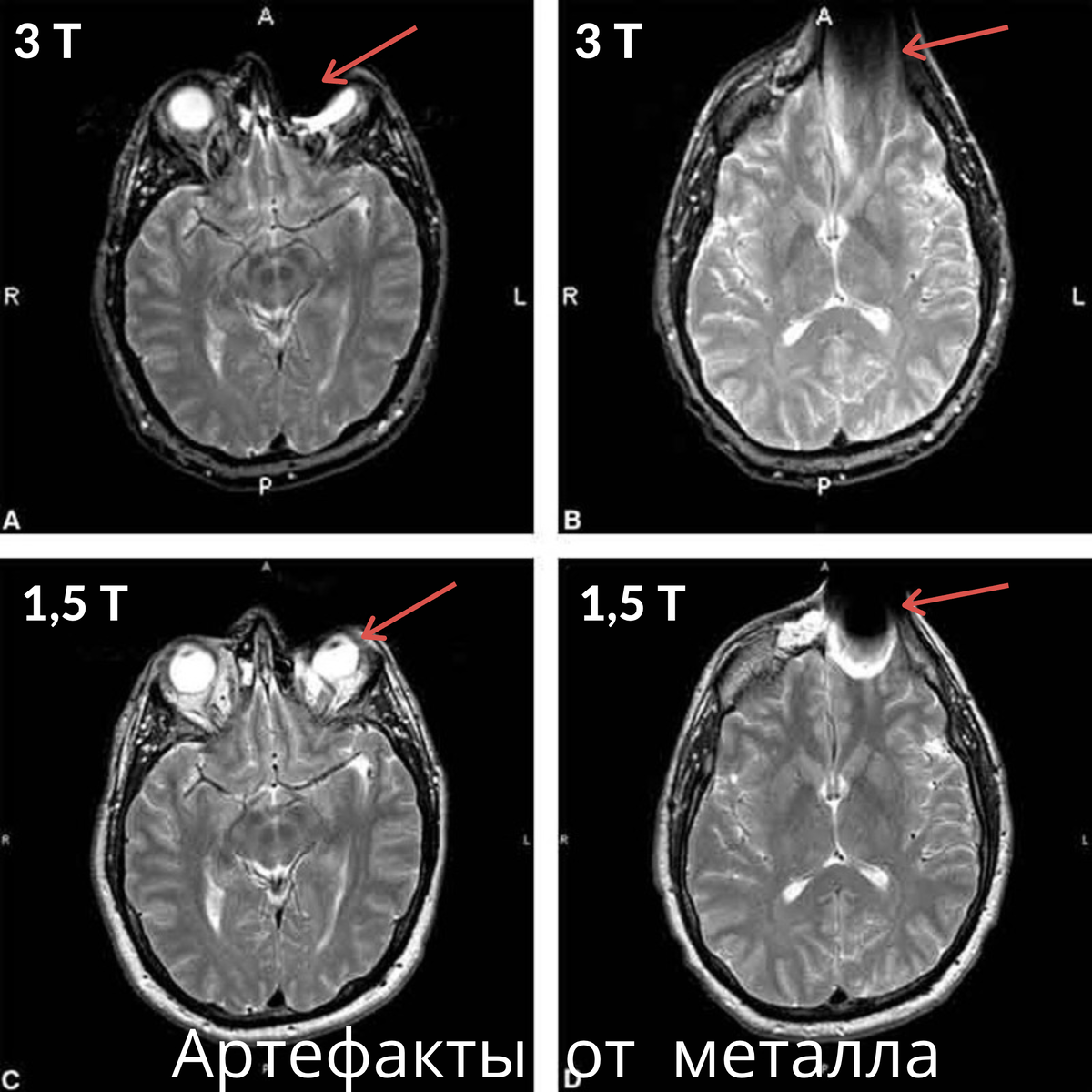 Мрт 3 тесла головного. Мрт 1.5 ТЛ. Мрт головного мозга 1,5 Тесла. Мрт 1 5 Тесла и 3 Тесла отличие.