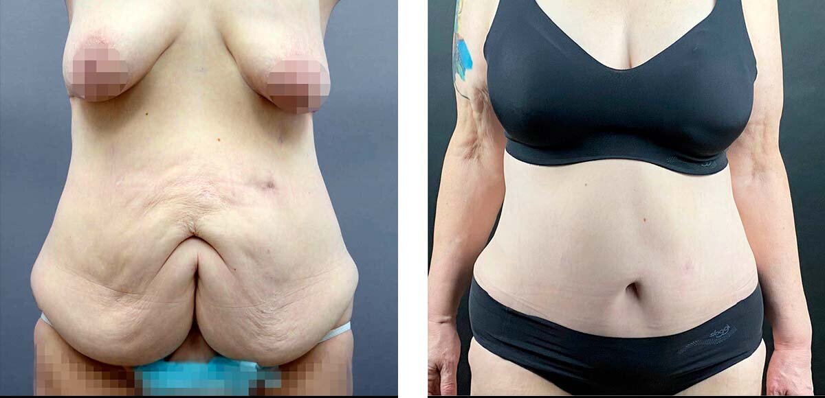 Результат абдоминопластики и подтяжки груди. Была проведена технически сложная, обширная операция с удалением большого объема мягких тканей. 