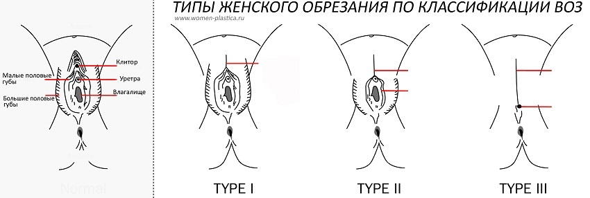 Удаление самого клитора или его части (Сунна) - такая операция делает клитор более открытым и чувствительным. Считается более безобидной, в сравнении с другими.  Удаление клитора и малых половых губ (Эксцизия) - наиболее распространенный и жестокий метод. Женщина теряет способность получать наслаждение от сексуального акта. Такой обычай наиболее широко распространен в Республике Кении, Северном Египте.  Отрезание малых или больших половых губ, смыкая поверхность ран и закрывая сам клитор (фараоново обрезание). Вход во влагалище закрыт и остается маленькое по размеру отверстие для выполнения функции мочеиспускания и месячных. Этот метод еще более жесток и вызывает больше вопросов, зачем его нужно проводить, чем ответов. После того, как девушку выдали замуж, делается небольшой надрез, чтобы во влагалище мог проникнуть мужской половой орган. Во время естественных родов отверстие во влагалище тоже рассекают.