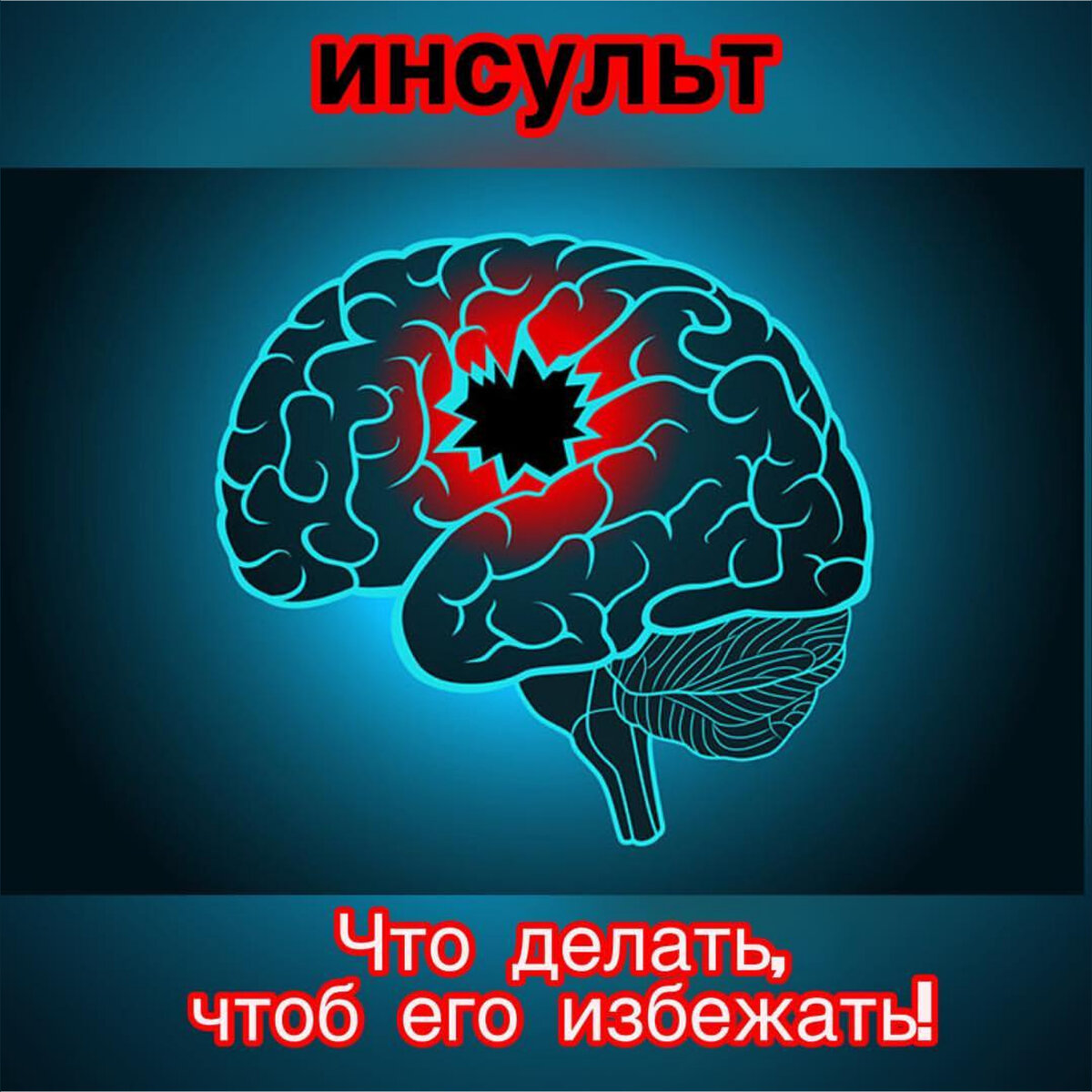 Инсульт - острое нарушение мозгового кровообращения