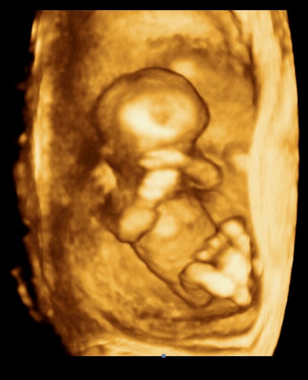 3D УЗИ. Срок беременности 12-13 недель.