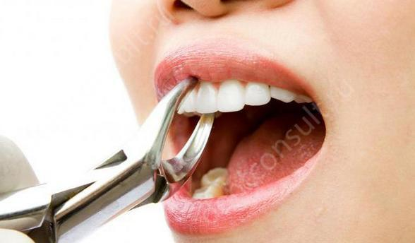 После удаления всегда будет боль – это нормальное следствие травмирования тканей. Фото: dentconsult.ru