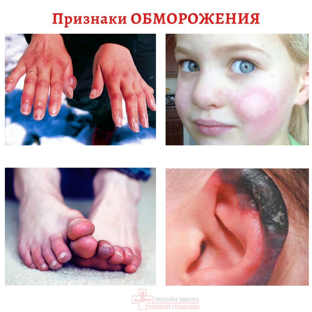 Обморозили щечки — 25 ответов | форум Babyblog