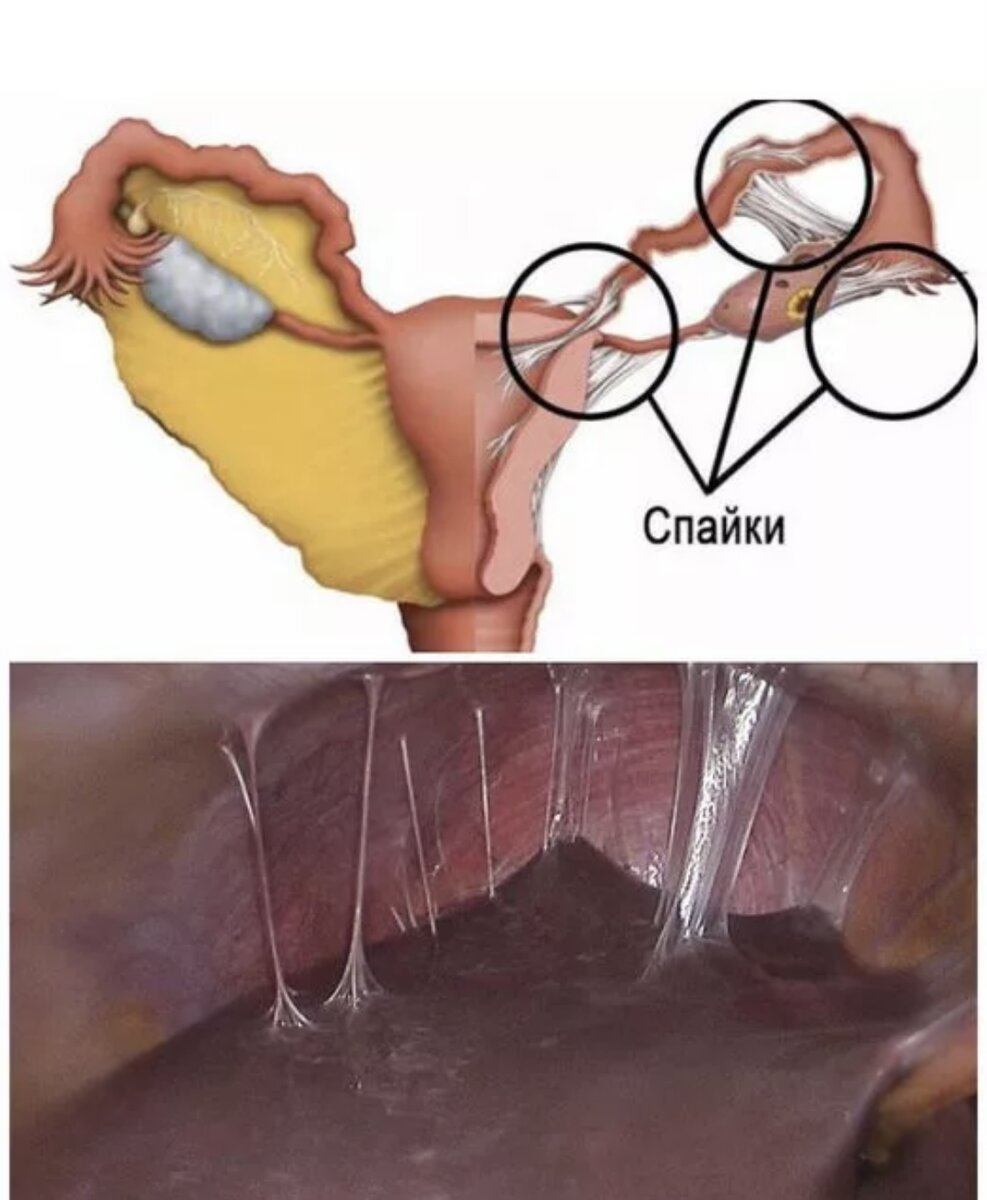 Спайки на яичниках картинки