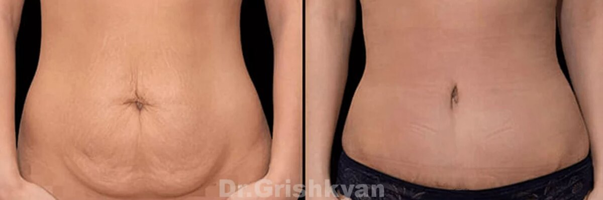 Абдоминопластика фото до и после. Фото с сайта Д.Р. Гришкяна. Имеются противопоказания, требуется консультация специалиста