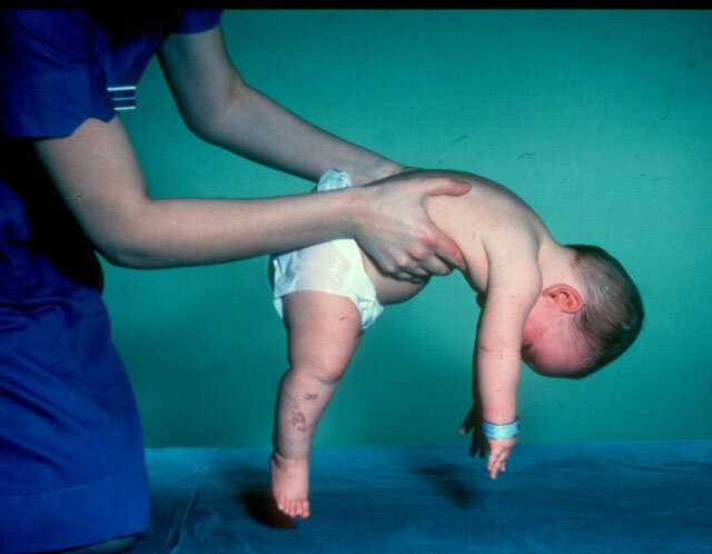 Этот малыш не может самостоятельно даже пошевелиться. Но ZOLGENSMA ему в этом сможет помочь. 