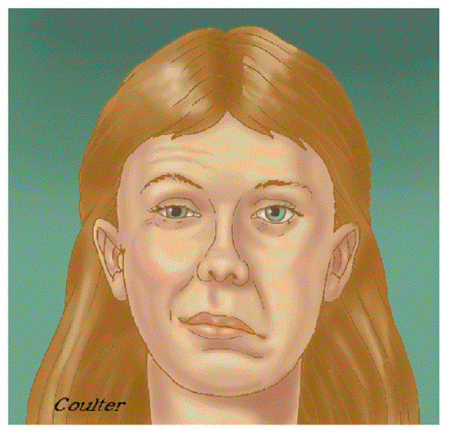 О данном синдроме во врачебной практике известно довольно давно, впервые он был описан в 1821 анатомом из Шотландии Чарльзом Беллом (откуда и получил свое название). Данное заболевание относится к периферической нервной системе и главным образом затрагивает лицевой нерв.