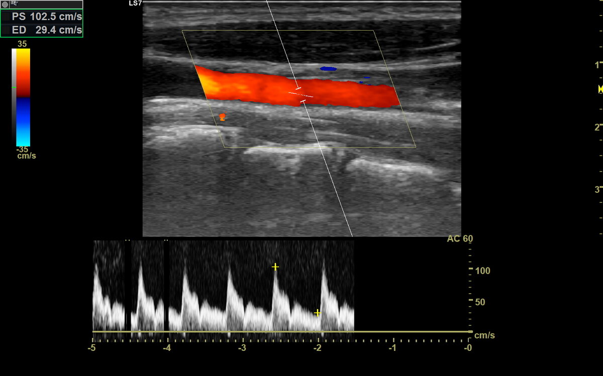 Дуплексное сканирование сосудов шеи
