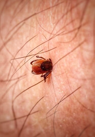 Клещ впился в кожу человека