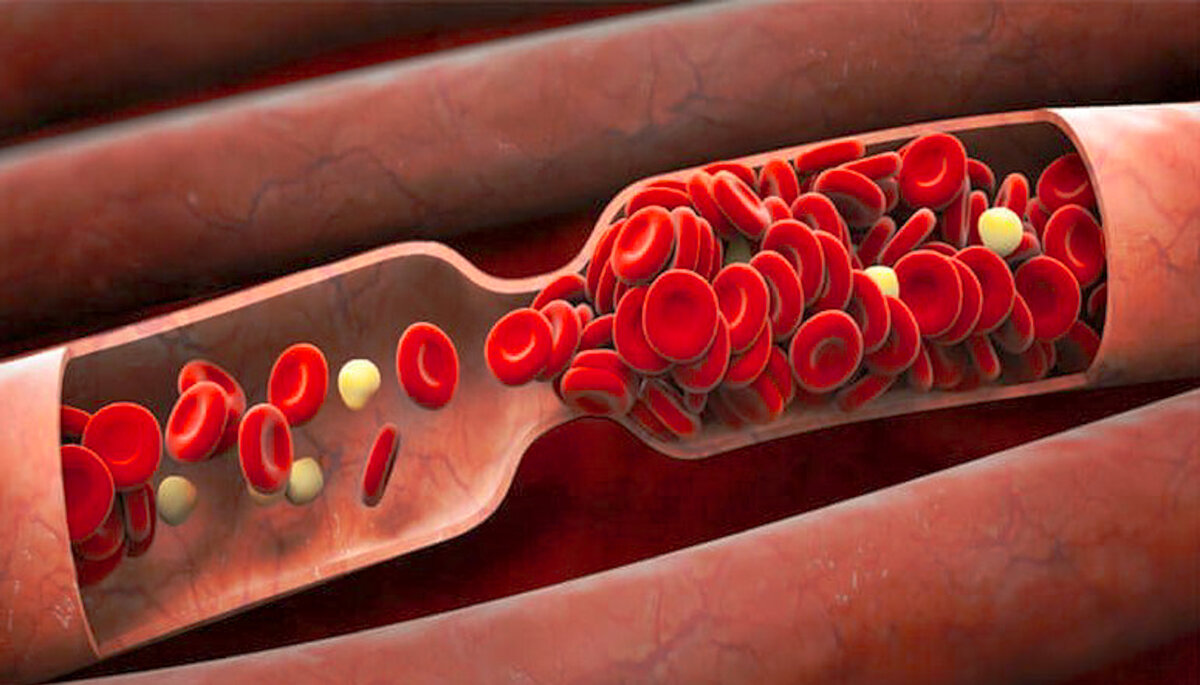 Вот что бывает при густой крови.