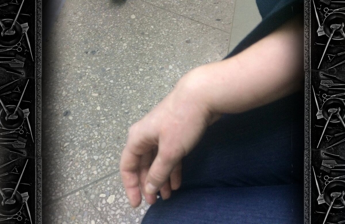 Закрытый перелом