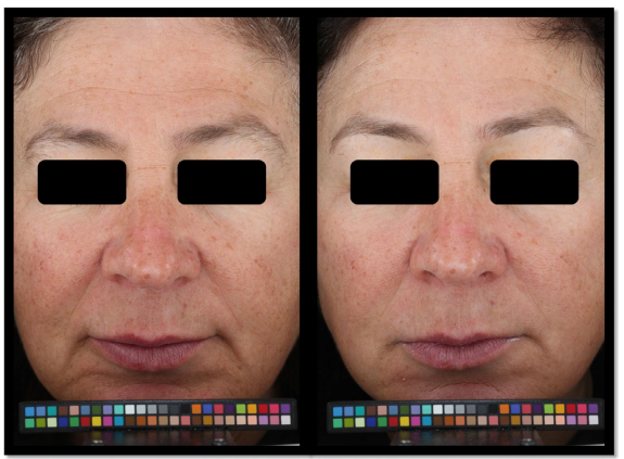 Судя по всему это один из самых лучших визуальных результатов. После 4 недель в усиленной программе ухода. 