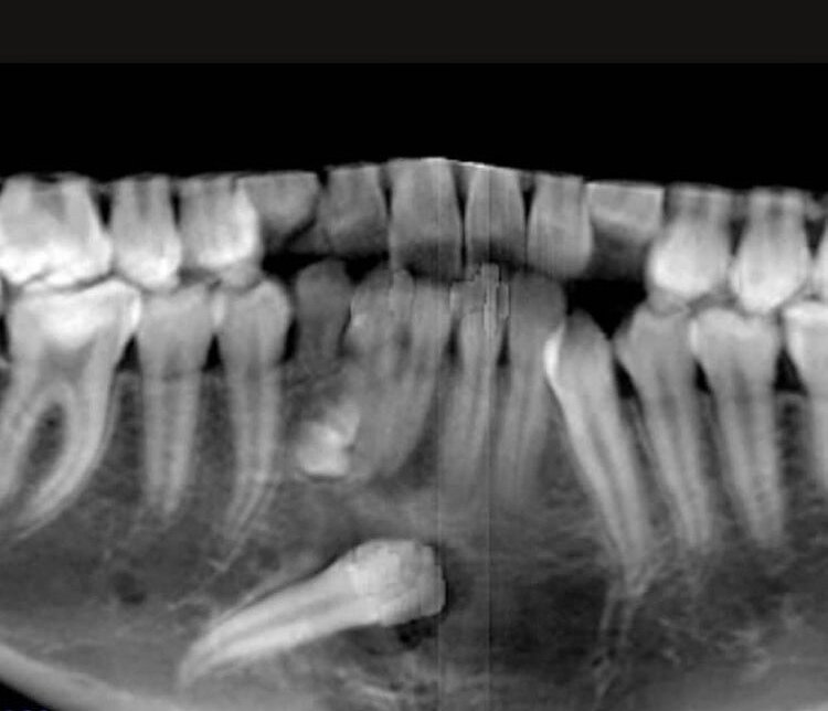 На фото кейс с клыком, который лежал в подбородке. Его «растили» наши доктора Дудина Ольга Александровна и Федосов Александр Викторович.