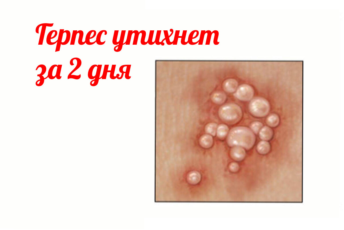 Как работает герпес и баночка Л-Лизина