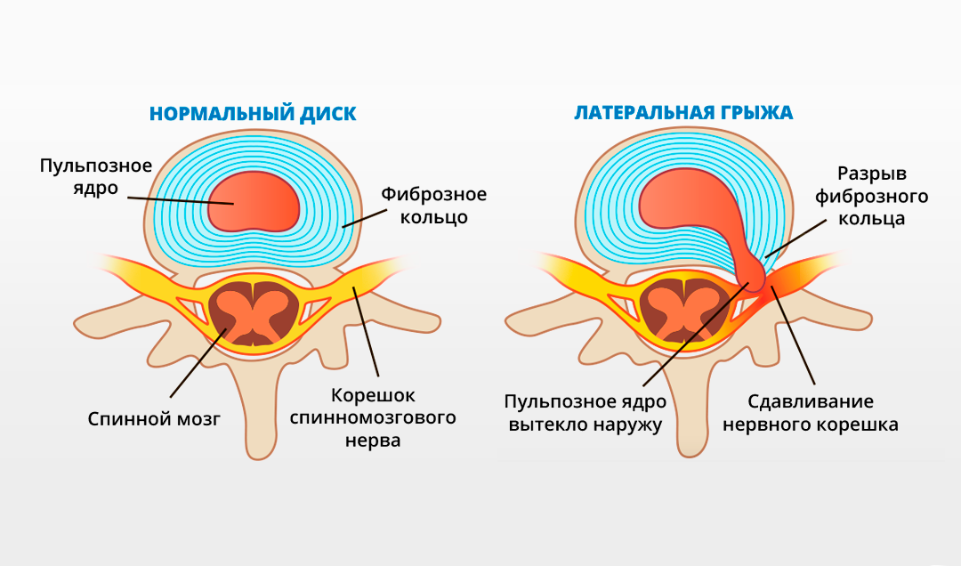 Секвестрированная грыжа позвоночника: размеры, лечение, последствия