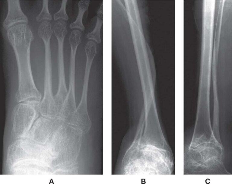    Рентгеновский снимок костей человека с несовершенным остеогенезом / ©Getty images