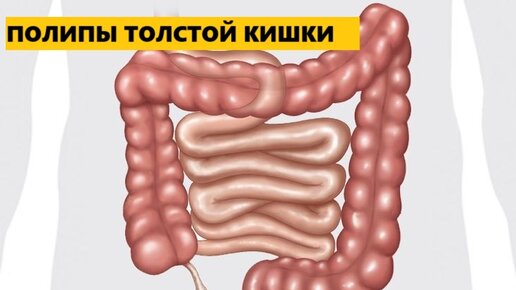 Полипы толстой кишки. Как себя вести? | Доктор Силантьева | Дзен