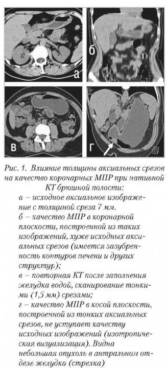 Качество пост процессинговых реконструкций напрямую зависит от характеристик исходных КТ-изображений, в первую очередь от толщины аксиальных срезов, а также использования внутривенного контрастного усиления. 

Для практической иллюстрации роли этих факторов все представленные в данной главе 2D- и 3D-реконструкции построены в результате обработки КТ-исследований только 2 пациентов
Пациентке Г. 46 лет с лимфомой желудка выполнено нативное (без внутривенного контрастного усиления) КТ-исследование брюшной полости с толщиной аксиальных срезов 7 мм. Опухолей в желудке при этом не выявлено. 

Через несколько дней КТ-исследование повторено после предварительного заполнения желудка водой peros для расправления его стенок. Сканирование осуществлено тонкими (1,5 мм) срезами, в результате чего выявлена небольшая опухоль в антральном отделе. Помимо иллюстрации возможностей различных видов вторичных реконструкций, данный пример демонстрирует важность правильной подготовки и методики КТ-исследования (рис. 1, 3, 5, 7, 10).

Пациенту Ш. 36 лет с хроническим панкреатитом и псевдокистой выполнена КТ брюшной полости с болюсным внутривенным контрастным усилением (КТ-ангиография, КТА) (рис. 2, 6, 8, 9, 11). Поскольку внутривенное контрастирование существенно повышает информативность некоторых видов КТ-реконструкций, сравнительное рассмотрение КТ-исследований 2 пациентов позволит лучше понять преимущества и недостатки каждого из основных видов постпроцессинга.

Мультипланарная реконструкция. После того, как исходные аксиальные КТ-изображения были реконструированы из сырых данных, они могут быть перестроены в любой плоскости – сагиттальной, коронарной, наклоненной (косой) или изогнутой (криволинейной). 

Получаемые при этом двухмерные изображения называют мультипланарными (многоплоскостными) реконструкциями или мультипланарными реформациями (МПР, англ. multiplanar reformation, MPR). Некоторые авторы считают термин «реформация» более правильным, поскольку он подчеркивает независимость создания МПР от сырых данных. В русскоязычной литературе чаще встречается термин «мультипланарная реконструкция».
