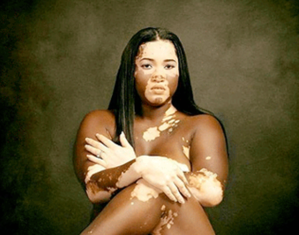 На фото: типичное проявление заболевания, под названием - витилиго.